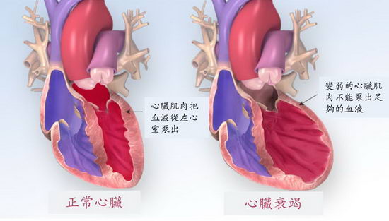 心脏衰竭患者日益增加新一代双效药物可减入院及死亡率